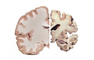 Alzheimer’s and the Brain